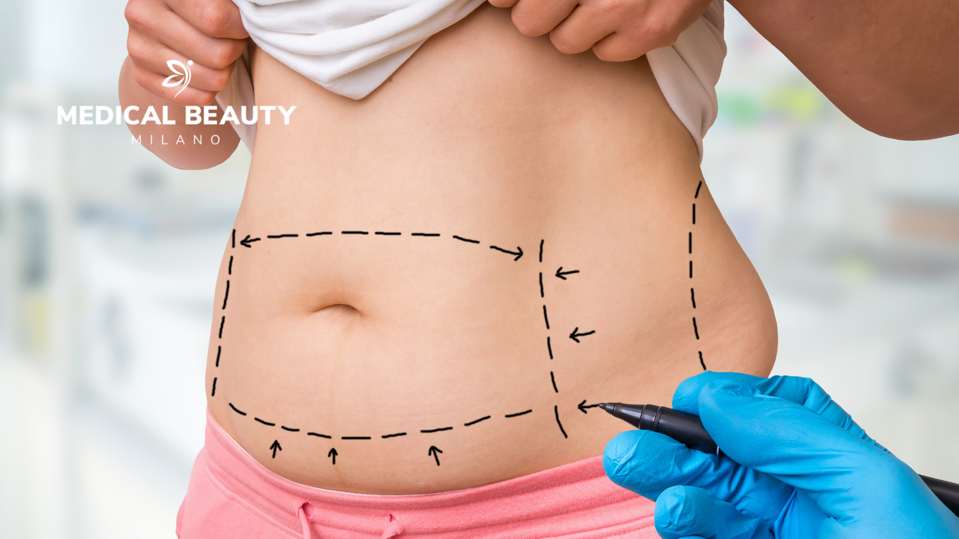 liposuzione